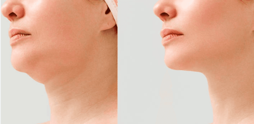 Redução De Papada Com 5 Sessões De Carboxiterapia + Enzima Redutora - foto 1